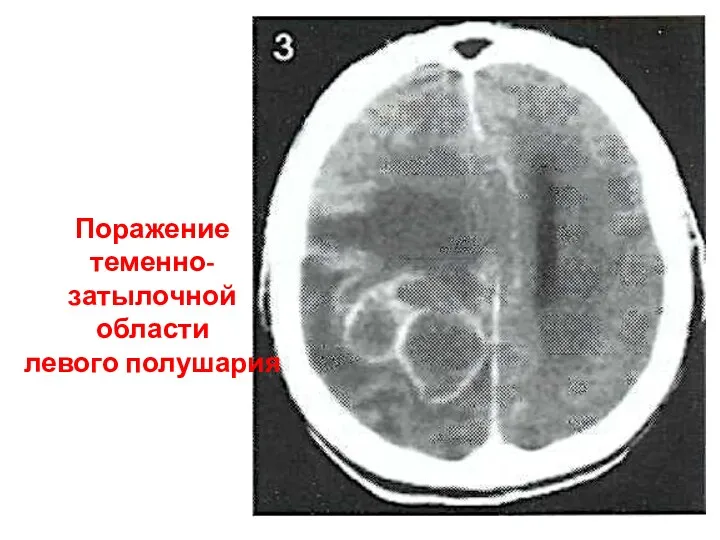 Поражение теменно-затылочной области левого полушария