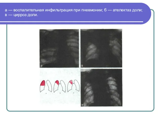 а — воспалительная инфильтрация при пневмонии; б — ателектаз доли; в — цирроз доли.
