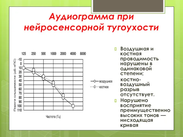 Аудиограмма при нейросенсорной тугоухости Воздушная и костная проводимость нарушены в