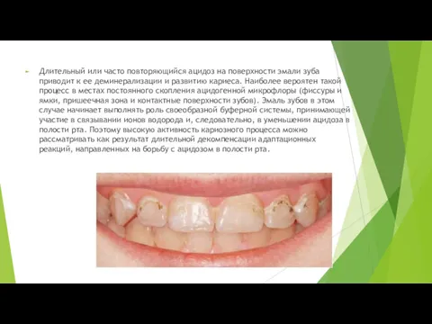 Длительный или часто повторяющийся ацидоз на поверхности эмали зуба приводит