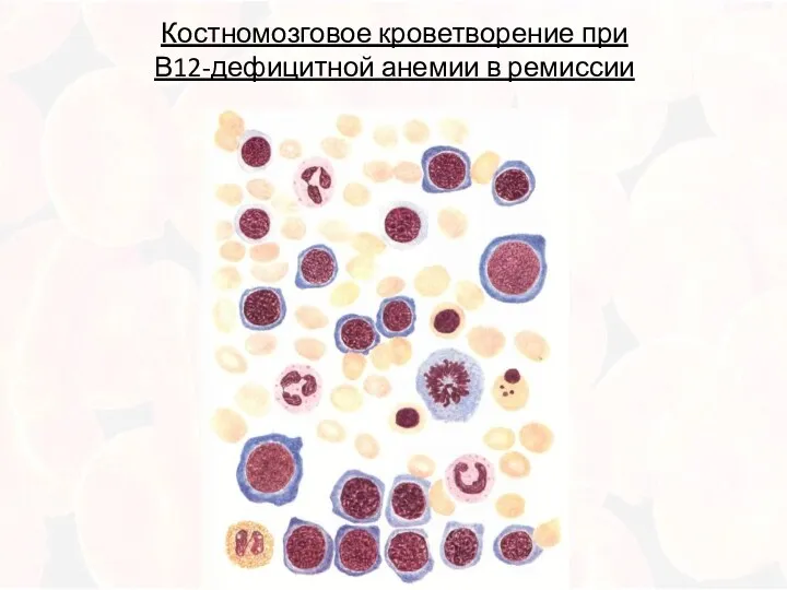 Костномозговое кроветворение при В12-дефицитной анемии в ремиссии