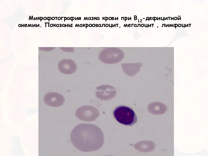 Микрофотография мазка крови при В12-дефицитной анемии. Показаны макроовалоцит, мегалоцит , лимфоцит