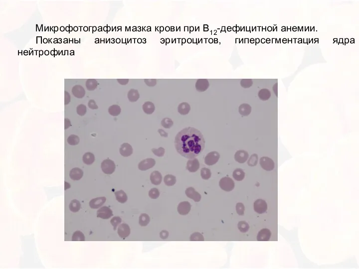 Микрофотография мазка крови при В12-дефицитной анемии. Показаны анизоцитоз эритроцитов, гиперсегментация ядра нейтрофила