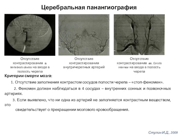 Церебральная панангиография Отсутствие контрастирования внутричерепных артерий Отсутствие контрастирования а. Vertebralis dextra на входе