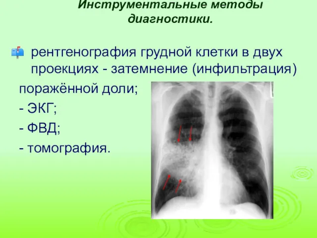 Инструментальные методы диагностики. рентгенография грудной клетки в двух проекциях -