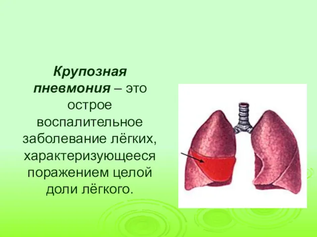 Крупозная пневмония – это острое воспалительное заболевание лёгких, характеризующееся поражением целой доли лёгкого.