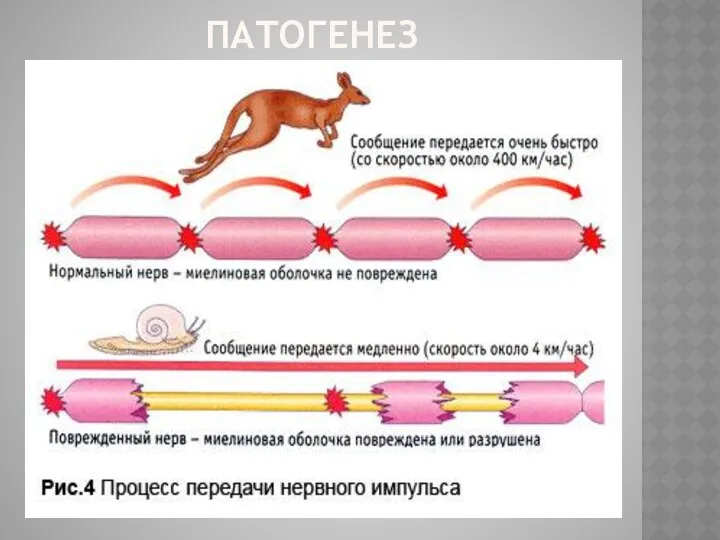 ПАТОГЕНЕЗ