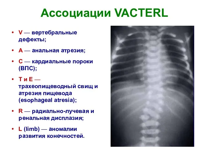 Ассоциации VACTERL V — вертебральные дефекты; А — анальная атрезия;