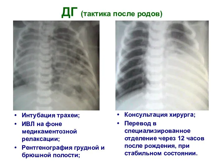 ДГ (тактика после родов) Интубация трахеи; ИВЛ на фоне медикаментозной релаксации; Рентгенография грудной