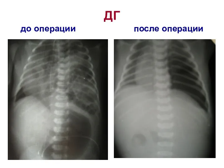 ДГ до операции после операции