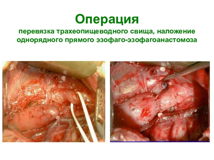 Операция перевязка трахеопищеводного свища, наложение однорядного прямого эзофаго-эзофагоанастомоза