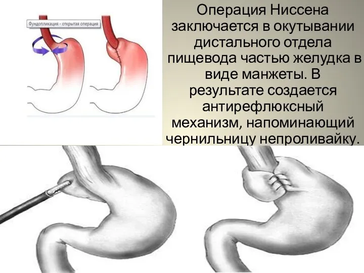 Операция Ниссена заключается в окутывании дистального отдела пищевода частью желудка в виде манжеты.