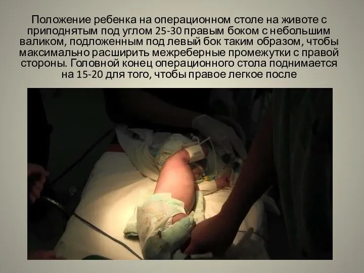 Положение ребенка на операционном столе на животе с приподнятым под углом 25-30 правым