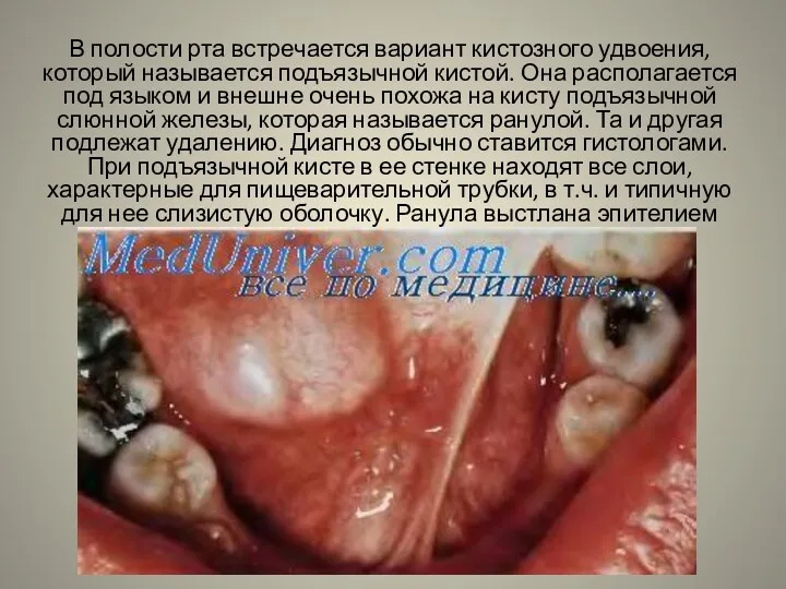 В полости рта встречается вариант кистозного удвоения, который называется подъязычной кистой. Она располагается