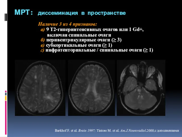 МРТ: диссеминация в пространстве Наличие 3 из 4 признаков: а)