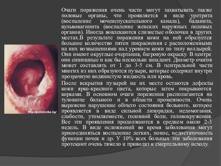 Очаги поражения очень часто могут захватывать также половые органы, что