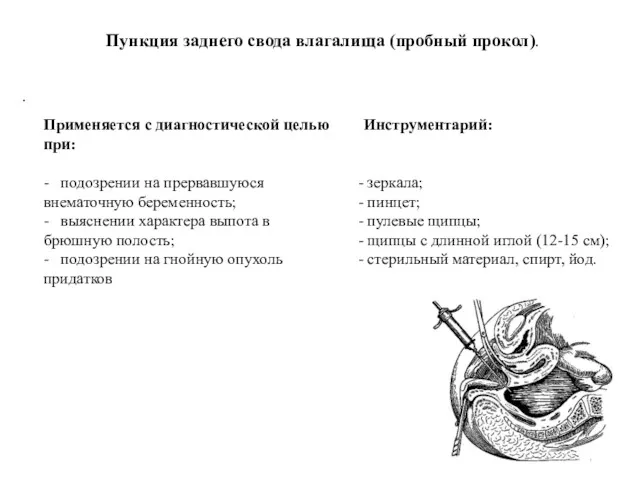 Пункция заднего свода влагалища (пробный прокол). Применяется с диагностической целью