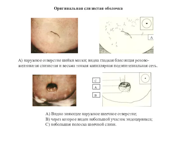 Оригинальная слизистая оболочка А) наружное отверстие шейки матки; видна гладкая блестящая розово-желтоватая слизистая