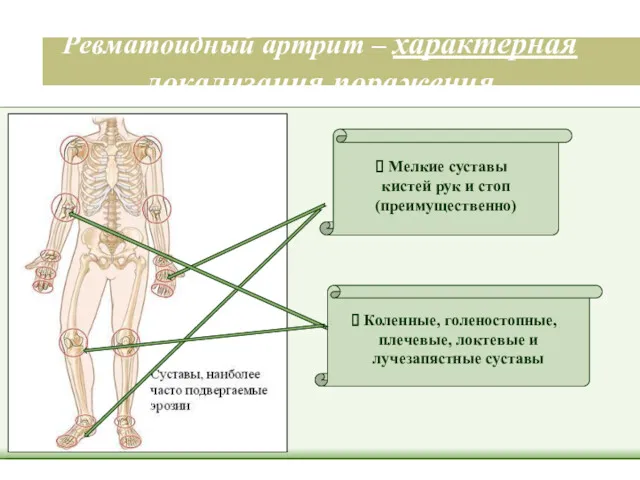 Ревматоидный артрит – характерная локализация поражения Мелкие суставы кистей рук