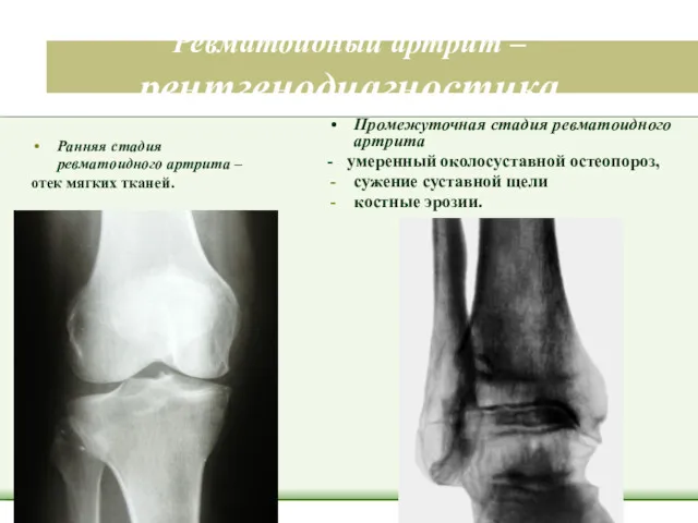 Ревматоидный артрит – рентгенодиагностика Ранняя стадия ревматоидного артрита – отек