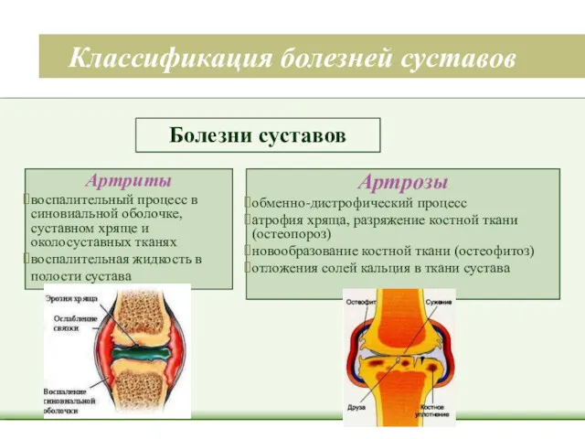 Классификация болезней суставов Болезни суставов Артриты воспалительный процесс в синовиальной