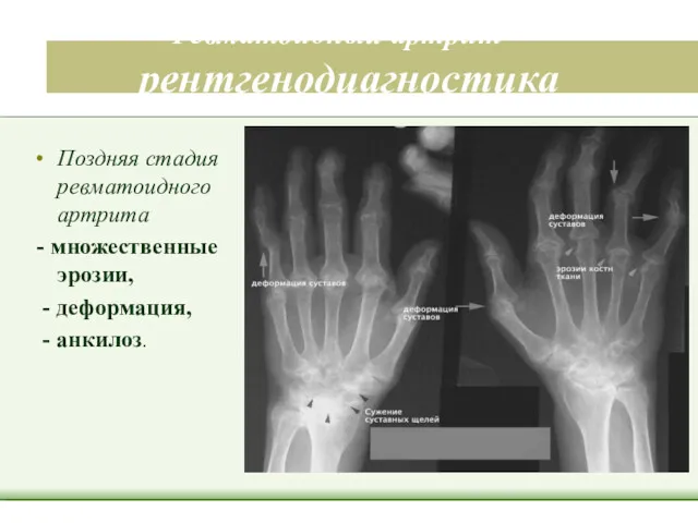 Ревматоидный артрит – рентгенодиагностика Поздняя стадия ревматоидного артрита - множественные эрозии, - деформация, - анкилоз.