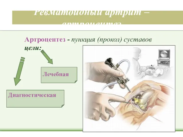 Ревматоидный артрит – артроцентез Диагностическая Лечебная Артроцентез - пункция (прокол) суставов цели: