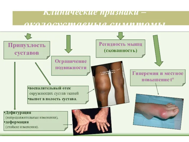 Клинические признаки – околосуставные симптомы воспалительный отек окружающих сустав тканей