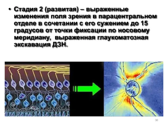 Стадия 2 (развитая) – выраженные изменения поля зрения в парацентральном