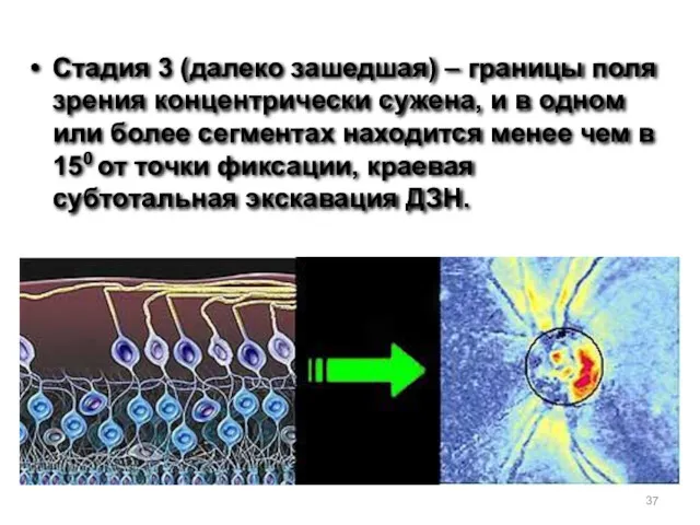 Стадия 3 (далеко зашедшая) – границы поля зрения концентрически сужена,