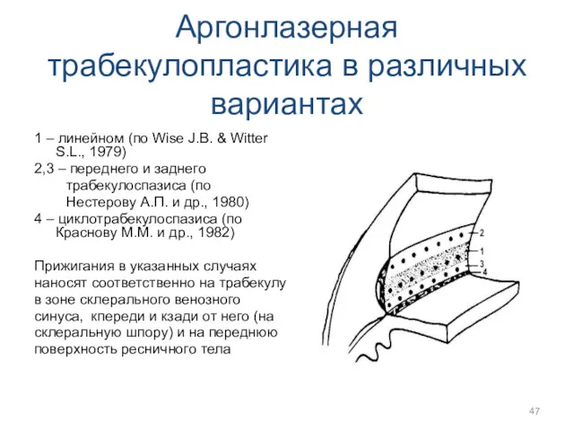 Аргонлазерная трабекулопластика в различных вариантах 1 – линейном (по Wise