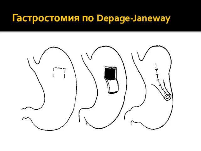 Гастростомия по Depage-Janeway