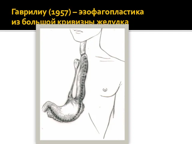 Гаврилиу (1957) – эзофагопластика из большой кривизны желудка
