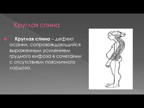 Круглая спина Круглая спина – дефект осанки, сопровождающийся выраженным усилением