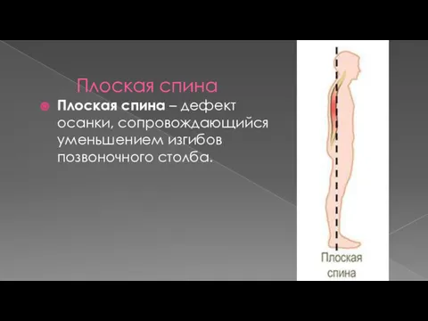 Плоская спина Плоская спина – дефект осанки, сопровождающийся уменьшением изгибов позвоночного столба.