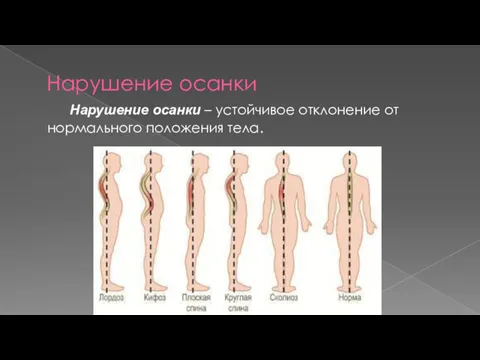 Нарушение осанки Нарушение осанки – устойчивое отклонение от нормального положения тела.