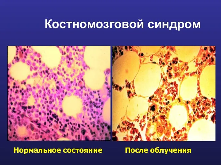 Костномозговой синдром Нормальное состояние После облучения