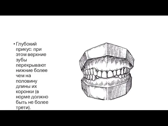 Глубокий прикус: при этом верхние зубы перекрывают нижние более чем