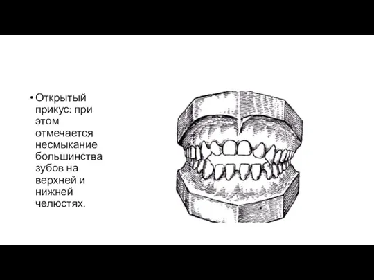 Открытый прикус: при этом отмечается несмыкание большинства зубов на верхней и нижней челюстях.