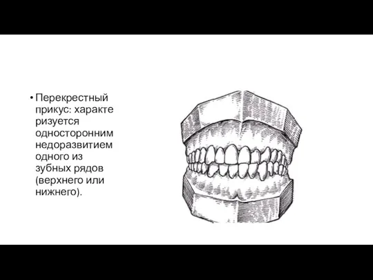 Перекрестный прикус: характеризуется односторонним недоразвитием одного из зубных рядов (верхнего или нижнего).