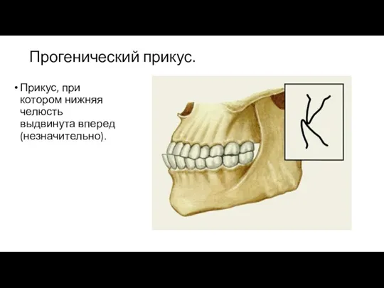 Прогенический прикус. Прикус, при котором нижняя челюсть выдвинута вперед (незначительно).