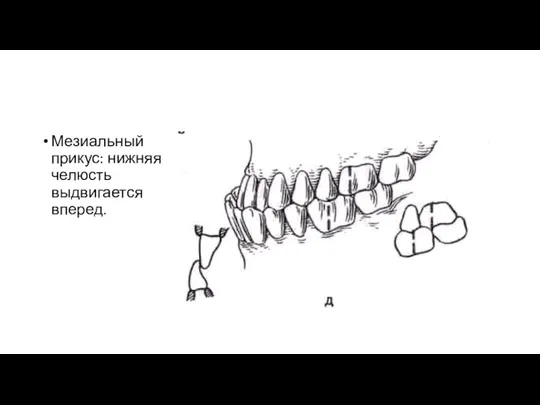 Мезиальный прикус: нижняя челюсть выдвигается вперед.