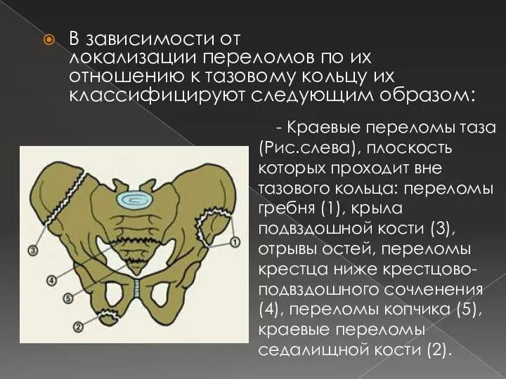 В зависимости от локализации переломов по их отношению к тазовому кольцу их классифицируют