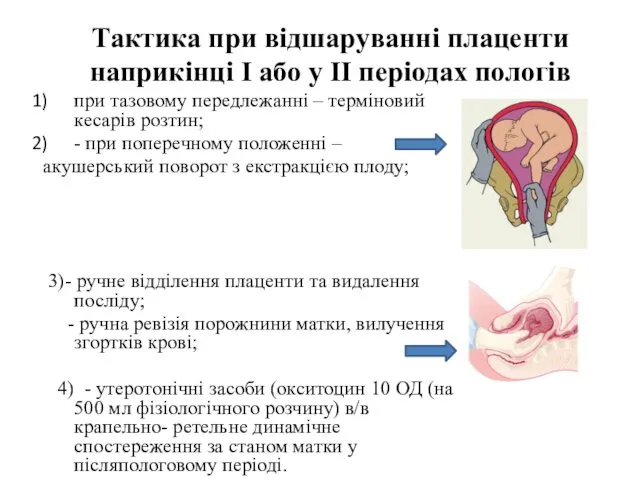 Тактика при відшаруванні плаценти наприкінці І або у II періодах пологів при тазовому