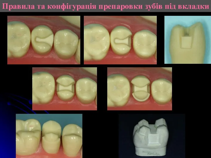 Правила та конфігурація препаровки зубів під вкладки