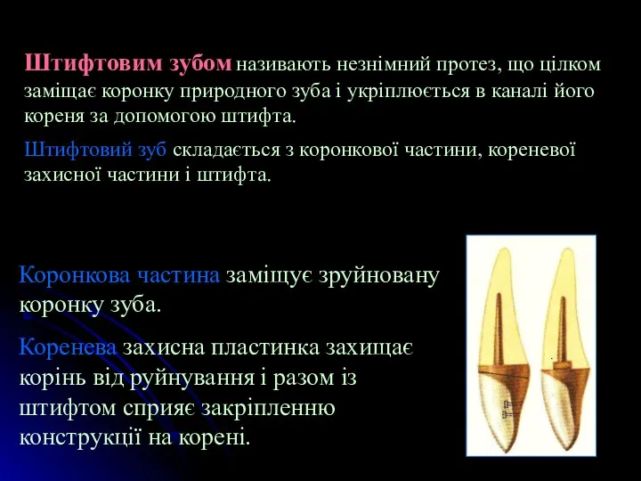 Штифтовим зубом називають незнімний протез, що цілком заміщає коронку природного