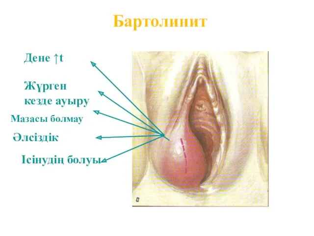 Бартолинит Дене ↑t Жүрген кезде ауыру Мазасы болмау Әлсіздік Ісінудің болуы