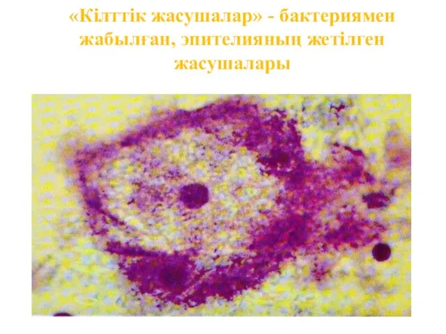 «Кілттік жасушалар» - бактериямен жабылған, эпителияның жетілген жасушалары