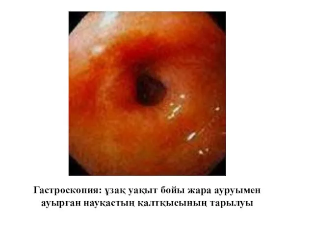 Гастроскопия: ұзақ уақыт бойы жара ауруымен ауырған науқастың қалтқысының тарылуы