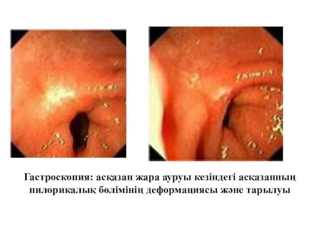 Гастроскопия: асқазан жара ауруы кезіндегі асқазанның пилорикалық бөлімінің деформациясы және тарылуы